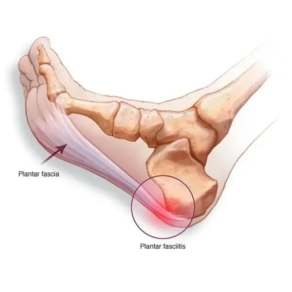 what is plantar fasciitis