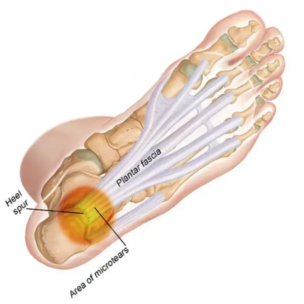 plantar fasciitis symptoms