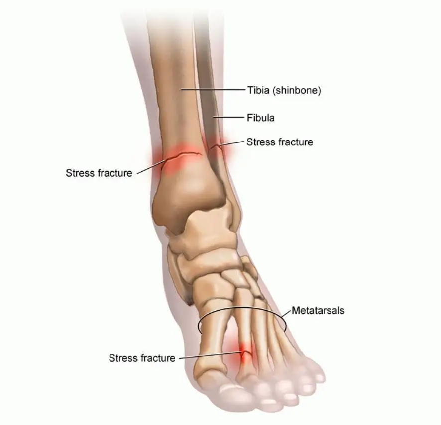 What is a stress fracture